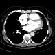 Lung embolism, subacute, lung infarct: CT - Computed tomography
